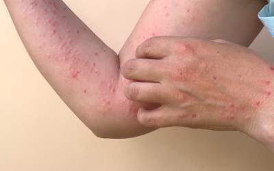 Alte două cazuri de infectare...