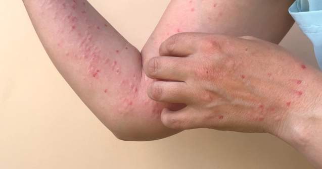 Alte două cazuri de infectare cu variola maimuței confirmate în România