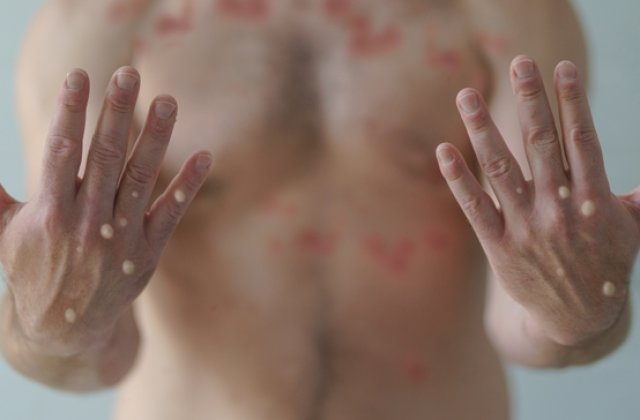 Două noi cazuri de variola maimuței raportate &icirc;n Rom&acirc;nia