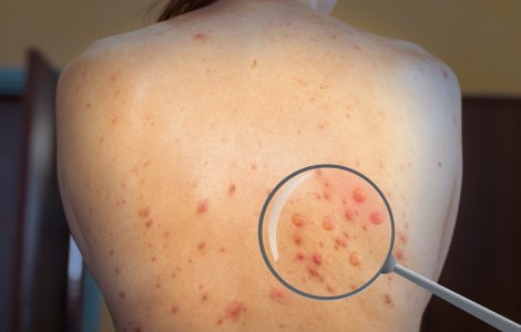 Peste 70.000 de cazuri de infectare cu variola maimuţei înregistrate în lume de la începutul epidemiei