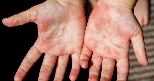 Epidemie de scarlatină în grădinițele și școlile din Vaslui