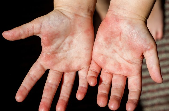 Epidemie de scarlatină &icirc;n grădinițele și școlile din Vaslui