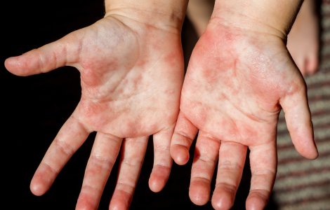 Epidemie de scarlatină în grădinițele și școlile din Vaslui