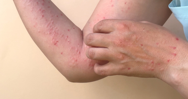 România înregistrează un nou caz de variola maimuței. Totalul cazurilor din țară