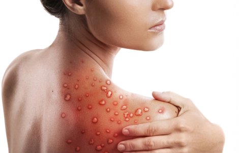 Un alt caz de variola maimuței în România. Bilanțul total