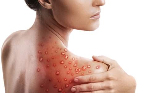 Un alt caz de variola maimuței în România. Bilanțul total