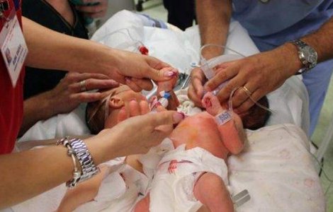  Foto  Starea siamezelor separate in urma cu 24 de ore este buna