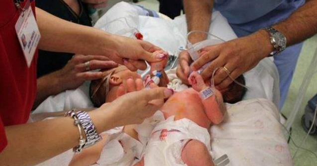  Foto  Starea siamezelor separate in urma cu 24 de ore este buna