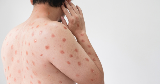 România înregistrează un nou caz de variola maimuței