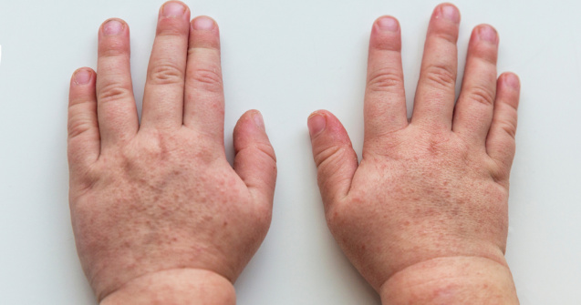 Epidemie cu o bacterie periculoasă în Marea Britanie. Șase copii au decedat