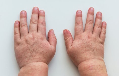 Epidemie cu o bacterie periculoasă în Marea Britanie. Șase copii au decedat