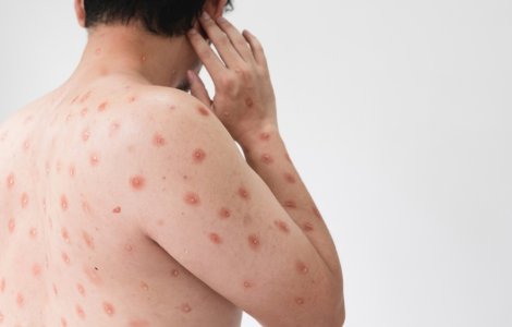 Un nou caz de variola maimuței în România. Câte cazuri au fost de raportate până în prezent