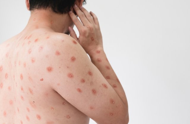 Un nou caz de variola maimuței &icirc;n Rom&acirc;nia. C&acirc;te cazuri au fost de raportate p&acirc;nă &icirc;n prezent