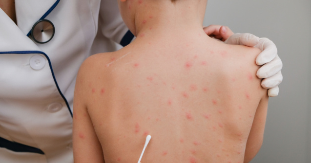 Copil de 7 ani cu o varicelă foarte rară, internat la Spitalul din Timișoara