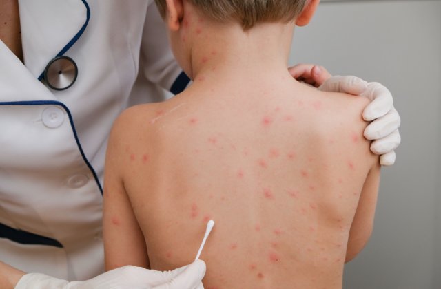 Un copil de 7 ani cu o formă de varicelă foarte rară, internat la Spitalul de Boli Infecțioase din Timișoara