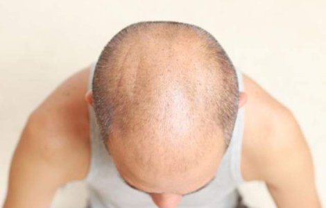 Barbatii cu chelie pot face mai usor cancer la prostata dar au libidoul ridicat