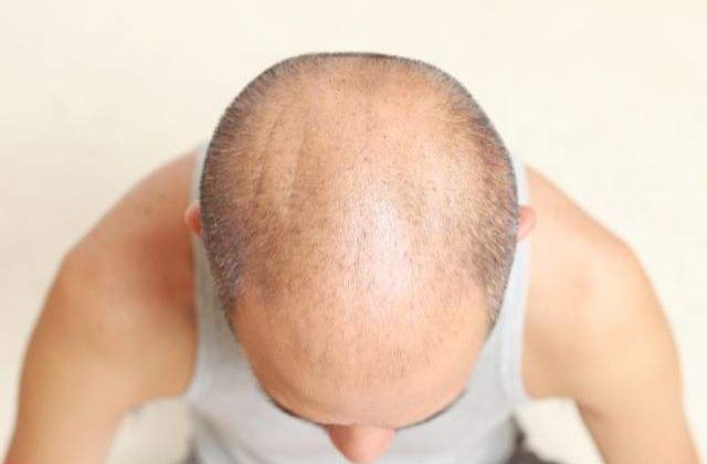 Barbatii cu chelie pot face mai usor cancer la prostata dar au libidoul ridicat