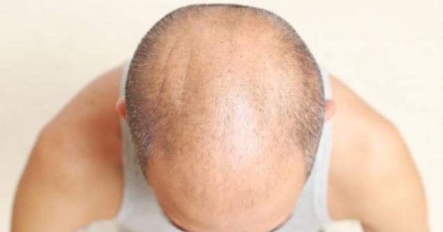 Barbatii cu chelie pot face mai usor cancer la prostata