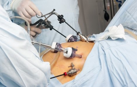 Gastric sleeve: Ce presupune operația de micșorare a stomacului