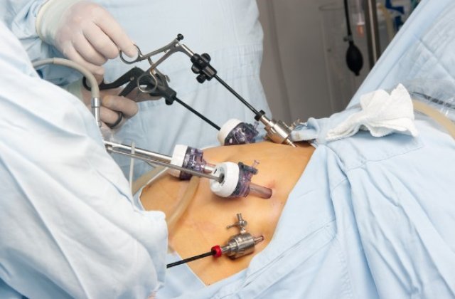 Gastric sleeve: Ce presupune operația de micșorare a stomacului