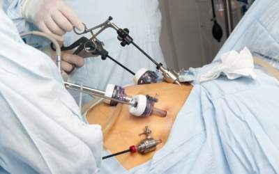 Gastric sleeve: Ce presupune...