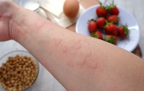 Ce este urticaria și de ce apare?
