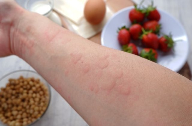 Ce este urticaria și de ce apare?