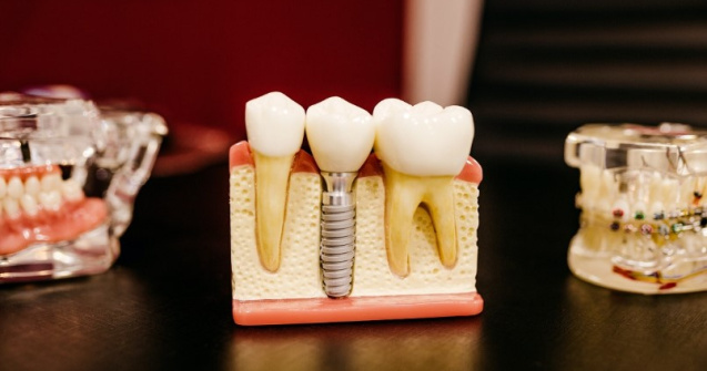 Implanturile dentare - Un tratament sigur și eficient pentru îmbunătățirea sănătății orale