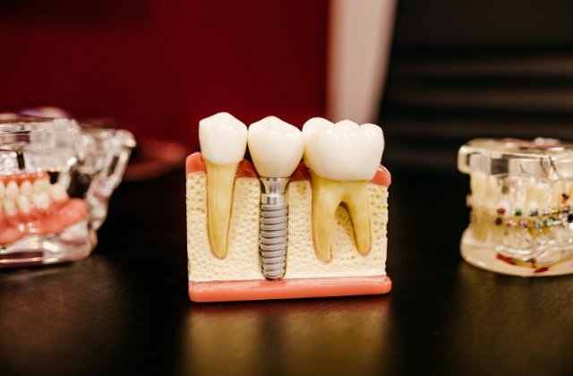 Implanturile dentare - Un tratament sigur și eficient pentru &icirc;mbunătățirea sănătății orale