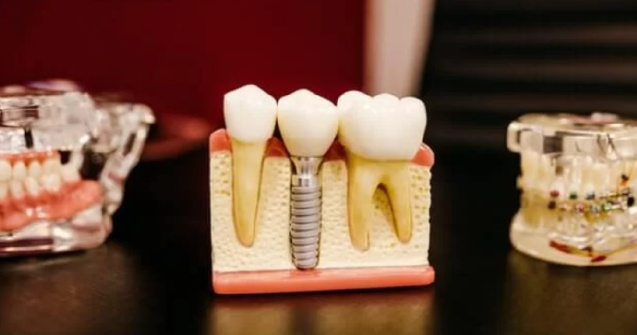 Află informații de care ai nevoie dacă dorești să apelezi la un implant dentar!