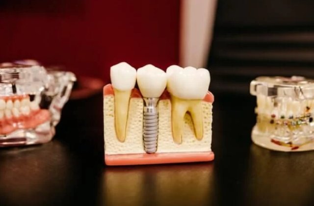 Află informații de care ai nevoie dacă dorești să apelezi la un implant dentar!