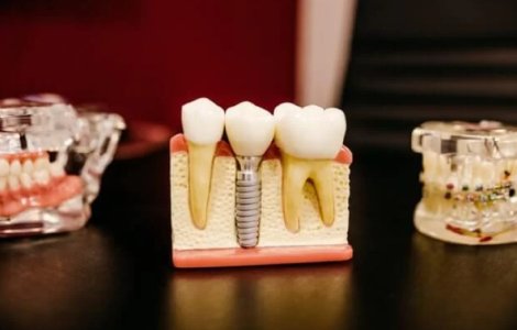 Află informații de care ai nevoie dacă dorești să apelezi la un implant dentar!
