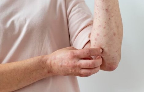 Varicela: cum se transmite și ce complicații pot apărea