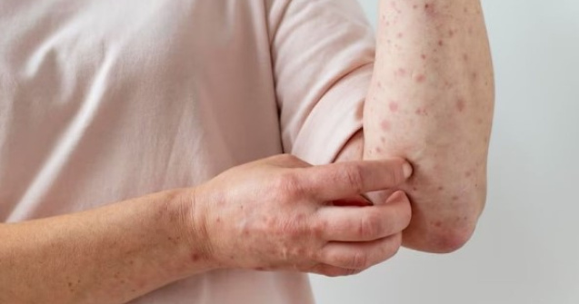 Varicela: cum se transmite și ce complicații pot apărea