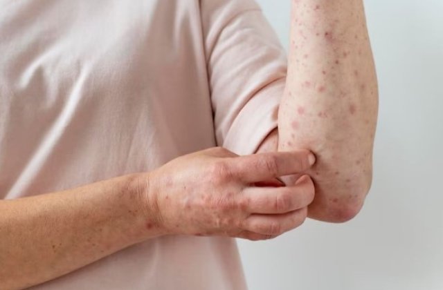 Varicela: cum se transmite și ce complicații pot apărea