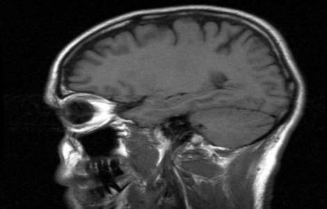 Infectia cu virusul Herpes dubleaza riscul de a suferi de Alzheimer