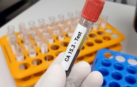 Cele mai comune tipuri de cancer depistate prin testarea antigenilor tumorali