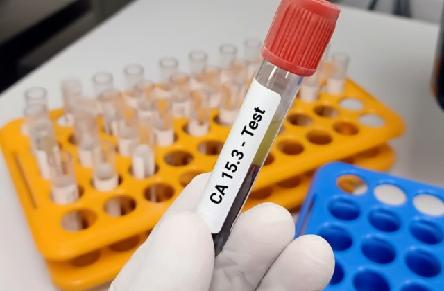 Cele mai comune tipuri de cancer depistate prin testarea antigenilor tumorali