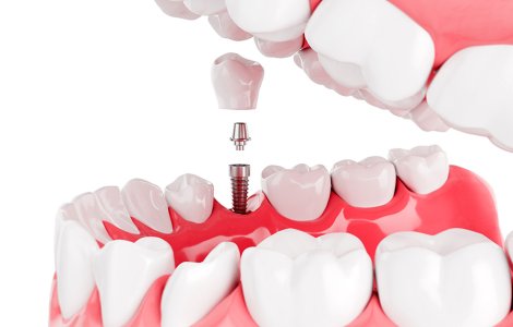 Care sunt etapele tratamentului cu implanturi dentare?