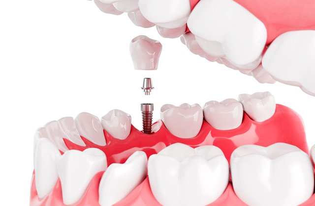Care sunt etapele tratamentului cu implanturi dentare?