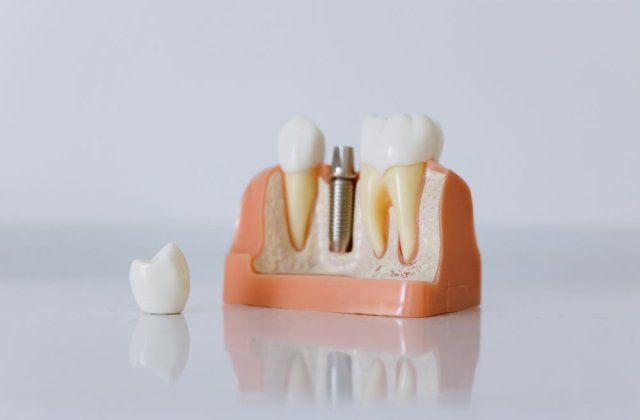Implanturi dentare vs punți dentare - care este cea mai bună opțiune pentru tine?