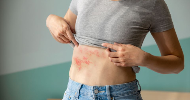 Zona Zoster: prin ce simptome se manifestă și cum se poate trata