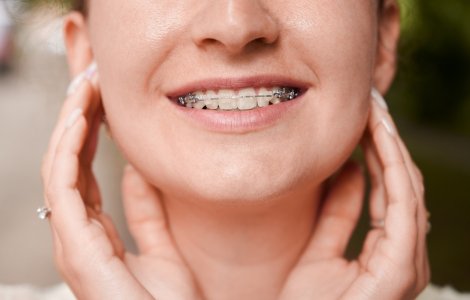 Aparatul dentar: secretul unui zâmbet perfect la orice vârstă