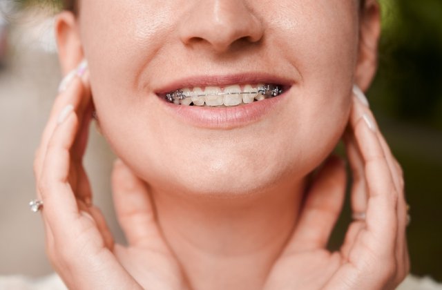 Aparatul dentar: secretul unui z&acirc;mbet perfect la orice v&acirc;rstă