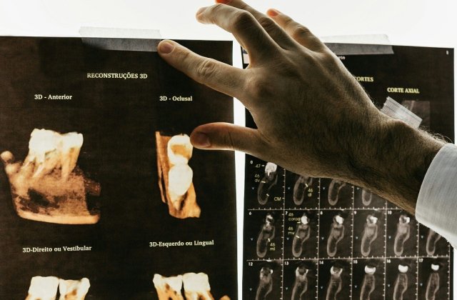  C&acirc;t de sigură este radiologia dentară și c&acirc;nd se recomandă?