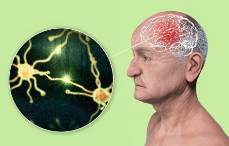 Descoperire care ar putea schimba totul: diagnosticarea Alzheimer prin sânge!