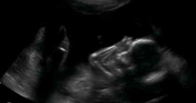 Studiu: Fetusii expusi la flatati au un nivel scazut de inteligenta