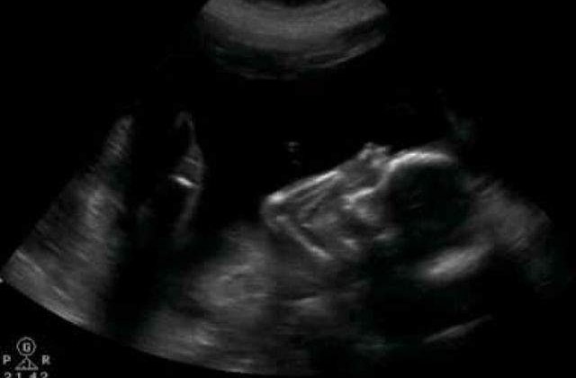 Studiu: Fetusii expusi la flatati au un nivel scazut de inteligenta