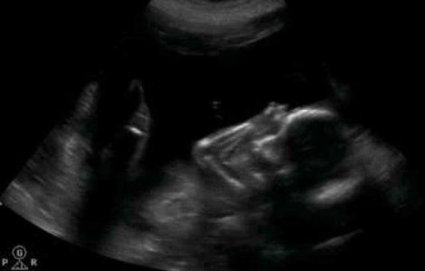 Studiu: Fetusii expusi la flatati au un nivel scazut de inteligenta