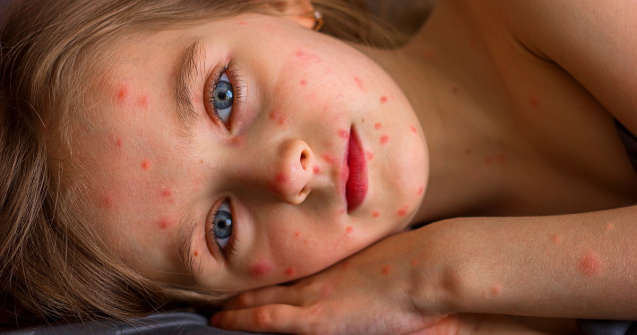 Tot ce trebuie să știi despre varicelă și cum să te protejezi